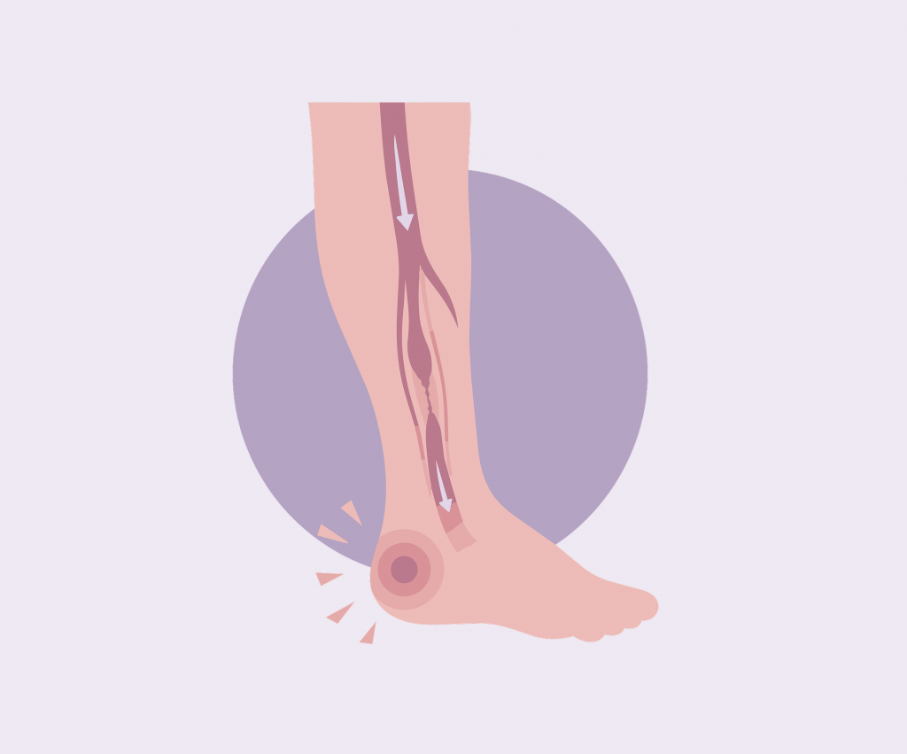 diagram of a leg with peripheral artery disease
