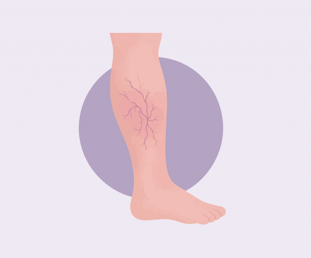 icon of a leg with spider veins